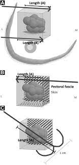 A positive margin means presence of cancer cells at that peripheral part of the specimen. Optimization Of Wire Guided Technique With Bracketing Reduces Resection Volumes In Breast Conserving Surgery For Early Breast Cancer Sciencedirect