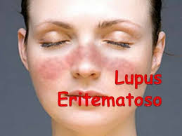 Sindrome coronario agudo