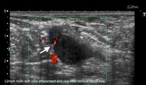 The breast tissue deflects these waves causing echoes, which a computer uses to paint a picture of what's going on inside the breast tissue (no radiation is involved). Fine Needle Aspiration Cytology Guided By Ultrasound Of Suspicious Axillary Lymph Nodes In Breast Cancer Patients