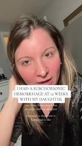 Perigestationalhemorrhage Hemorrhage Meaning What