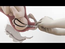 Image result for Forceps Assisted Delivery