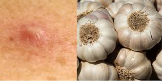 Cara menghilangkan bisul dengan lidah buaya mudah. Pengobatan Bisul Pakai Bawang Putih Caranya Sangat Mudah Ini Faktanya Semua Halaman Grid Health