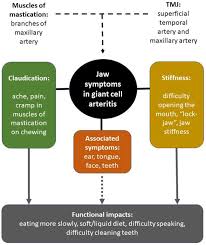 Image result for Jaw Claudication