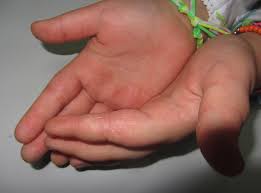 Image result for dermatitis contacta children