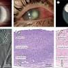 Effect on prevention of epithelial keratitis and stromal keratitis. Https Encrypted Tbn0 Gstatic Com Images Q Tbn And9gctehgzdd 88sqro8fbnrmyxq6c1njx1igyvvh8ikm 1w9j32dwd Usqp Cau