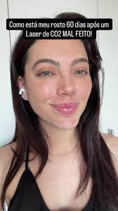 Tratamento de Olheiras com Laser CO2