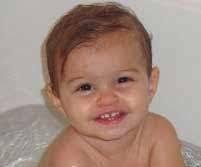 Toddler recovering from hot-water burns