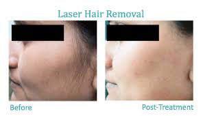 Our laser clinics and medical spas often offer before & after pictures for laser hair removal. Laser Hair Removal Lafayette Co Arejuvenation Skin Care
