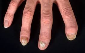 Image result for onychomycosis