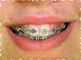 Black And White Braces Color This Would Be Fun For Halloween Don T Want Black On My Teeth Braces Colors Cute Braces Colors Braces Treatment