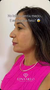 Ela se arrependeu 😲!!, Dra Madame💎, #harmonizacaofacial #fy #dramadame💎  #fyp #preenchimento #autoestima #trend #viral, #mulheresempreendedoras  #draednameloo, #harmonizaçãofacial , Curtidas e postagens