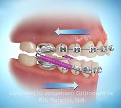 Kiss Your Overbite Goodbye With Forsus Springs In 2020 Teeth Braces Orthodontics Overbite Correction