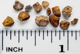 What Causes Kidney Stones Symptoms Remedy Surgery The imaging tests show the issues leading to stone formation, that is, whether it is a birth defect or a block in the urinary tract. what causes kidney stones symptoms