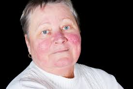 Image result for red rash face