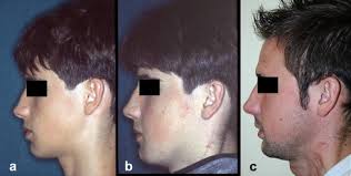 Microvascular reconstruction of mandibular defects in paediatric patients