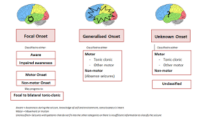 seizure types and classification epilepsy action australia