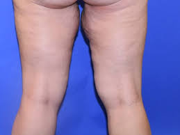 Post Weight Loss Inner Thigh Lift Performed On Houston Area Female
