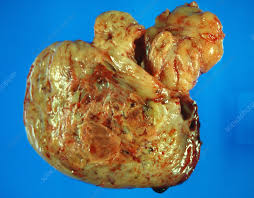 Image result for Leiomyosarcoma