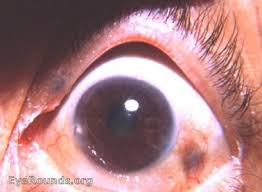 Image result for lesion sclera
