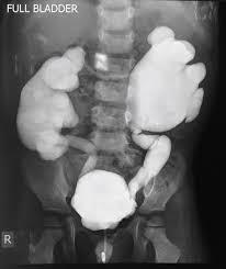 Image result for Voiding Cystourethrogram