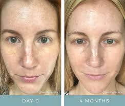 Image result for Hyperpigmentation