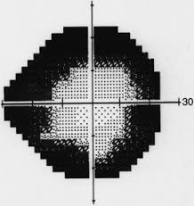 Image result for Visual Field Deficit