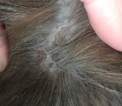 If you observe circular lesions accompanied by hair loss, it is most likely that your cat has ringworm. Susan Smyth On Twitter My Cat Has A Scaly Rash The Entire Length Of Her Spine She Has Antibiotics Special Wash Etc Does Anyone Know What This Is And How To Soothe
