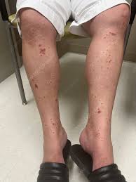 Image result for Vasculitis