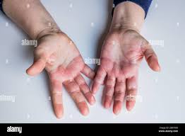 Dermatitis Atopica Roja Picazon En Las Manos Con Ampollas Y Piel Agrietada Fotografia De Stock Alamy