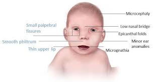Pin On Fetal Alcohol Syndrome