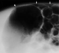 Necrotizing enterocolitis (nec) is the most common gastrointestinal emergency in the neonatal intensive care unit. Necrotizing Enterocolitis Review Of State Of The Art Imaging Findings With Pathologic Correlation Radiographics