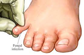 Fungus treatment between the toes is held under the supervision of a physician. Athlete S Foot Infection Family Podiatry Of Maryland