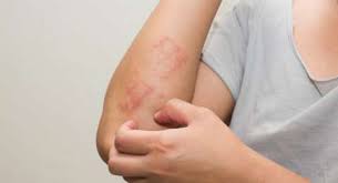 Namun sayangnya kolesterol tinggi sering hadir tanpa disadari. Psoriasis Bisa Jadi Tanda Kolesterol Tinggi Ini Hubungannya