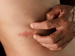 Image result for shingles