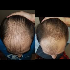 Microneedling goes beyond shedding a layer of skin to reduce the appearance of scars and actually encourages new growth by wounding the skin with tiny punctures, stimulating collagen production. Minoxidil Dermarolling Hair Loss Drugs Hair Restoration Network Community For And By Hair Loss Patients