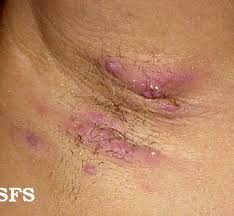 Image result for sore skin in the groin area