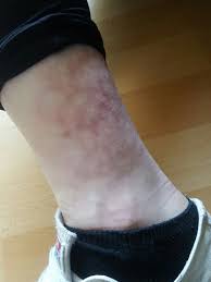 Was Sind Das Fur Rote Flecken Am Fuss Gesundheit