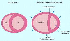 Image result for Right Heart Failure