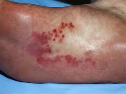 Image result for dyshidrosis