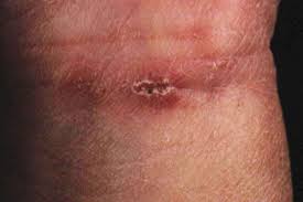 Mythos Kratze Was Stimmt Was Nicht Derma Plus