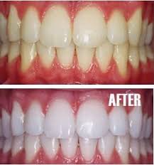 Make Yellow Teeth White How To Whiten Your Teeth At Home Health And Beauty Beauty Hacks Diy Beauty