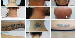 I'm considering getting a tattoo removed. What I Have Learned After More Than 8500 Tattoo Removal Treatments Mike Anderson