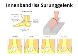 Alles zum thema fuß umgeknickt verständlich erklärt. Innenbandriss Am Sprunggelenk Ursache Symptome Therapie