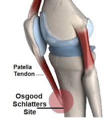 Osgood Schlatters Exercises Knee Pain Explained