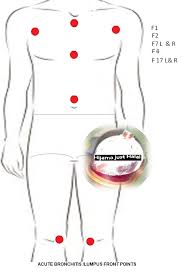 Facebook Hijama Cupping Therapy Cupping Points