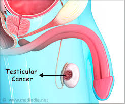 Testicular cancer is highly treatable, even when cancer has spread beyond the testicle. Quiz On Testicular Cancer