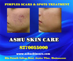 Find opening hours for skin care clinics near your location and other contact details such as address, phone number, website. Best Dermatologist In Bhubaneswar Skin Hair Treatment Specialist In Bhubaneswar Cuttack Odisha Ashu Skin Care