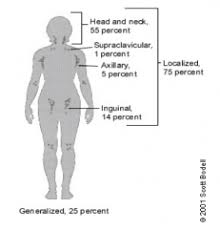 Submental lymph node is one of the lymph nodes in the body located in the neck just below the chin. Symptoms 12 Lymphadenopathy Flashcards Cram Com