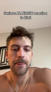 Never doing that again #allergic #kiwi #reaction