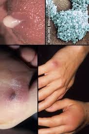 We did not find results for: Kumpulan Obat Sipilis Pada Pria Tatalaksana Sipilis